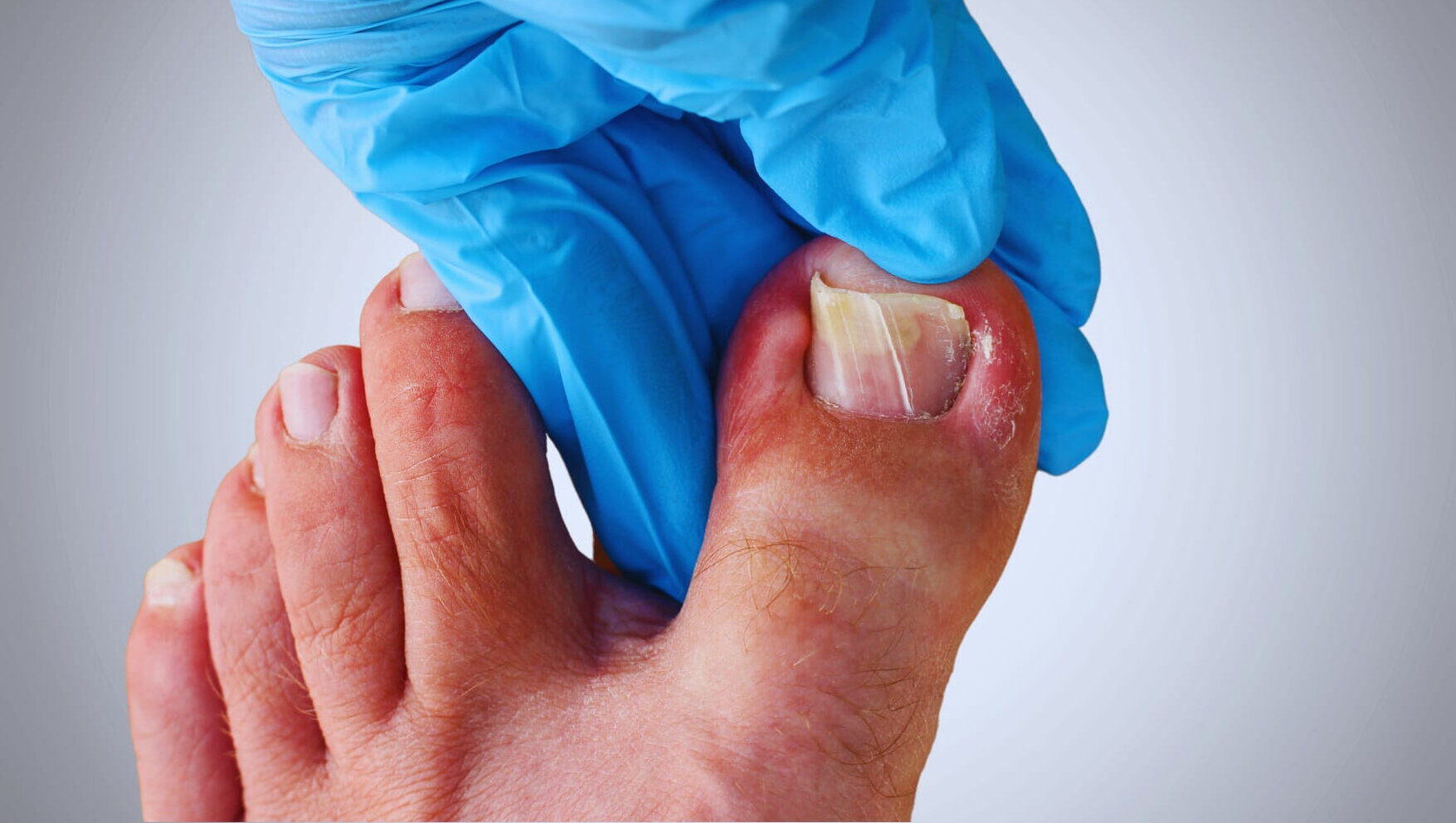 ingegroeide teennagel_page-0001 (1)